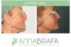 LIFTING-VISO