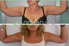 LIFTING-braccia
