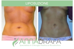 Liposuzione