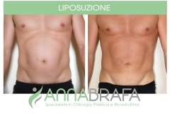 Liposuzione