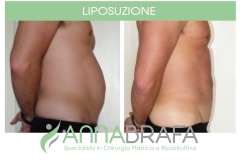 Liposuzione