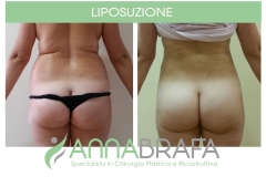 Liposuzione