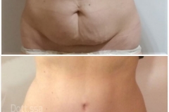Liposuzione
