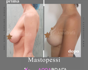 Mastopessi