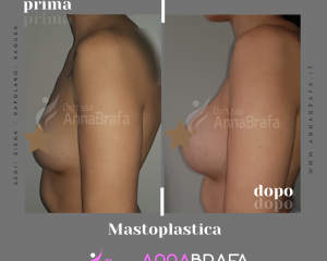 Mastoplastica-12