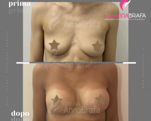 Anna Brafa Pre Post