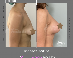 Anna Brafa Pre Post