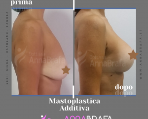 Mastoplastica-Additiva-2b