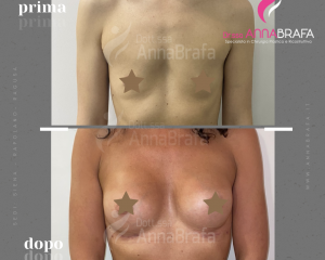 Anna Brafa Pre Post