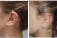 OTOPLASTICA--RIMODELLAMENTO-CARTILAGINE