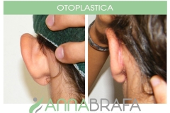 OTOPLASTICA