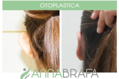 OTOPLASTICA