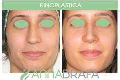 RINOPLASTICA