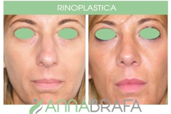 RINOPLASTICA