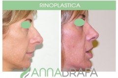 RINOPLASTICA