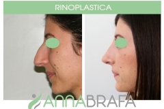 RINOPLASTICA