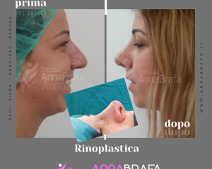 Anna Brafa Pre Post