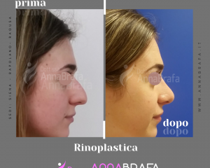 Anna Brafa Pre Post