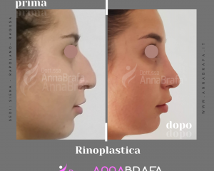 Anna Brafa Pre Post