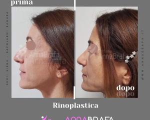 Anna Brafa Pre Post