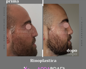 Anna Brafa Pre Post