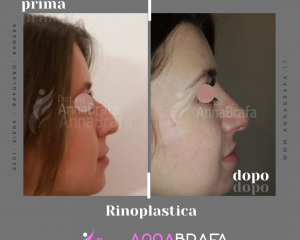 Anna Brafa Pre Post