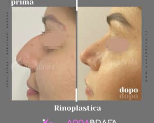 Anna Brafa Pre Post