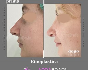 Anna Brafa Pre Post